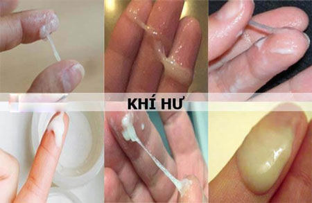 Khí hư loãng như sữa do nhiễm khuẩn âm đạo