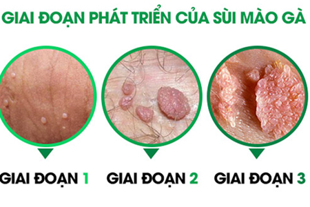 Chi phí điều trị bệnh sùi mào gà