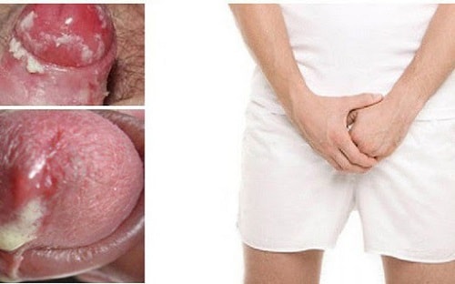 Triệu chứng của bệnh lậu ở nam giới