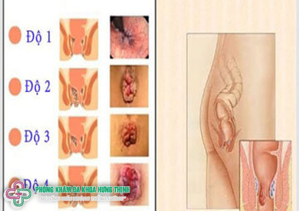 Bệnh trĩ là gì? Các dạng trĩ thường gặp hiện nay