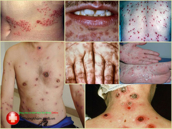 Bệnh giang mai ở nam, nữ giới là gì có chữa được không