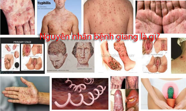 Nguyên nhân bệnh giang là gì?