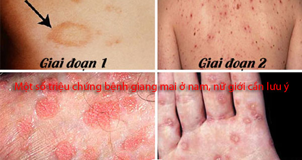 Một số triệu chứng bệnh giang mai ở nam, nữ giới cần lưu ý