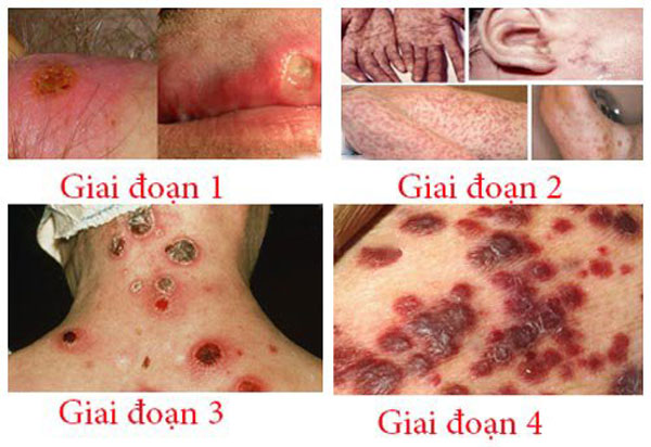 Các giai đoạn và dấu hiệu của bệnh giang mai