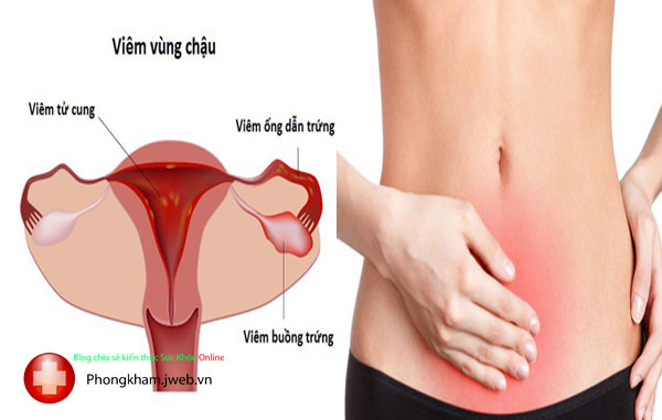Triệu chứng viêm vùng chậu là gì có nguy hiểm không?