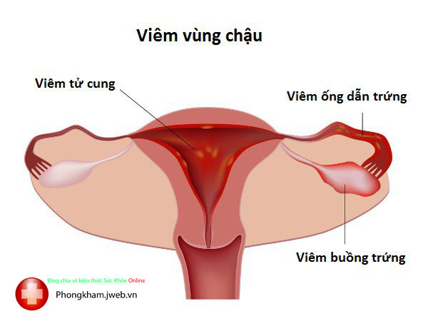 Bệnh viêm vùng chậu là gì?