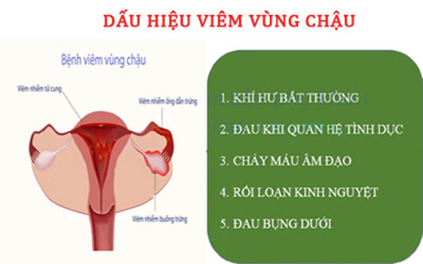 Dấu hiệu viêm vùng chậu là gì