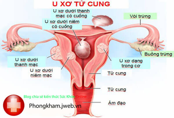 U xơ tử cung là gì? tại sao phải mổ u xơ tử cung