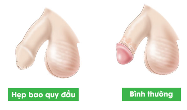 Hẹp bao quy đầu là gì?