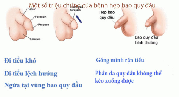 Một số triệu chứng của bệnh hẹp bao quy đầu