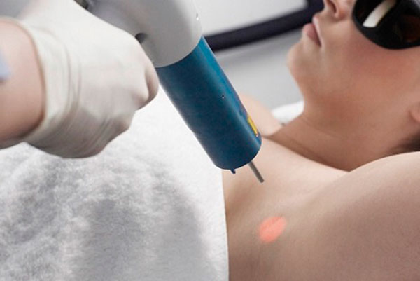 Cách chữa bệnh hôi nách tận gốc bằng tia laser