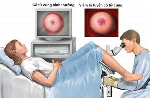 Viêm lộ tuyến cổ tử cung có nên đốt không