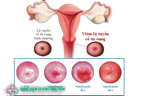 Viêm cổ tử cung là gì?