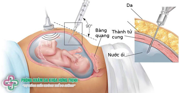 Sàng lọc trước sinh là gì? Tại sao bà bầu nên thực hiện?
