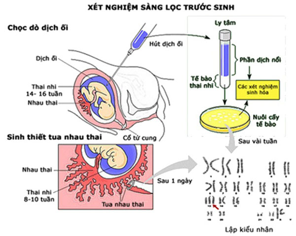 Xét nghiệm NIPT sàng lọc trước sinh