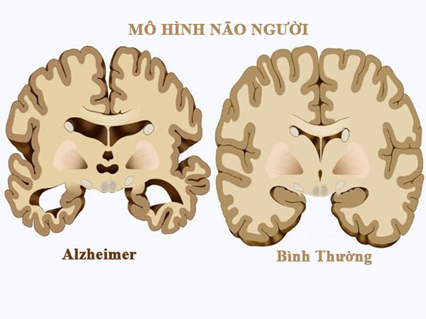Nguyên nhân gây bệnh Alzheimer là gì?