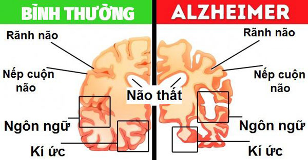 Dấu hiệu nhận biết bệnh Alzheimer