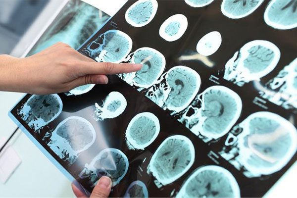 Cách chẩn đoán và điều trị bệnh Alzheimer