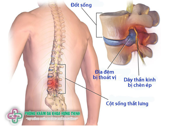 Thoát vị đĩa đệm thắt lưng là gì