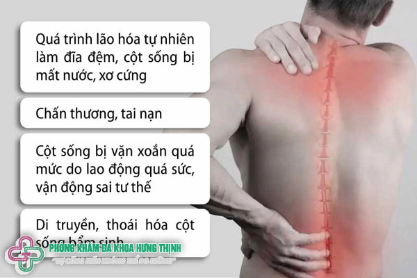 Nguyên nhân gây đau thoát vị đĩa đệm thắt lưng