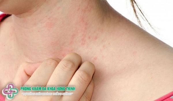 Hiện tượng sốt phát ban ở người lớn