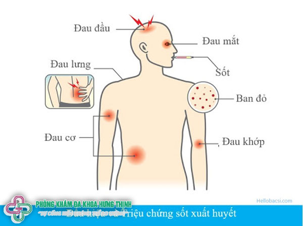 Dấu hiệu sốt phát ban ở người lớn