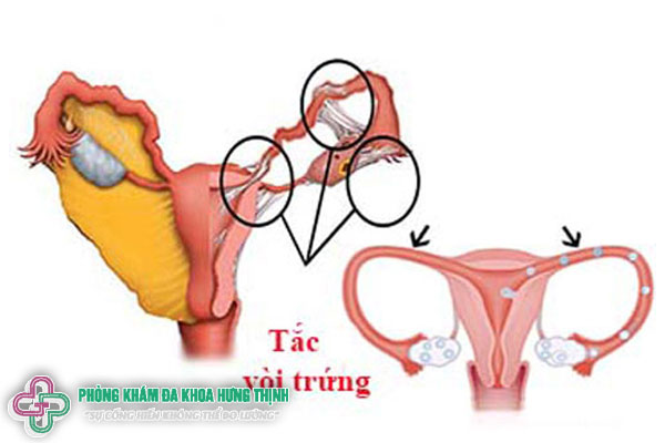 Tắc vòi trứng là Nguyên nhân gây vô sinh ở nữ giới