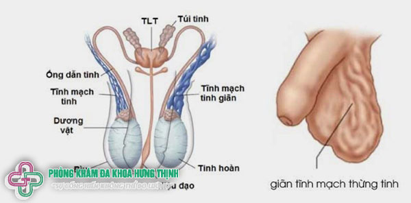 Tổng quan về bệnh giãn tĩnh mạch tinh hoàn