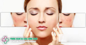 Nám mặt là gì? nguyên nhân và cách chữa trị nhanh nhất tại nhà