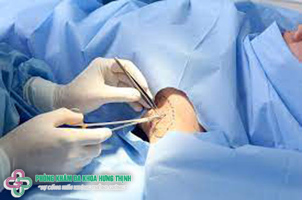 Một số thông tin về phương pháp phẫu thuật cắt tuyến mồ hôi nách