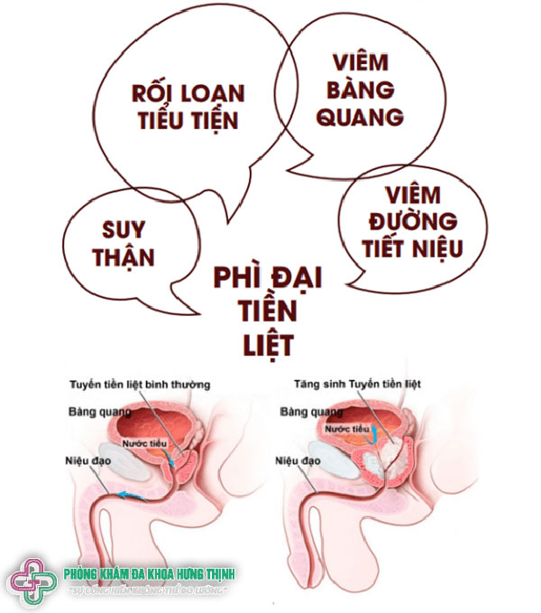 Nguyên nhân tiểu rắt