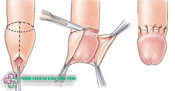 Cách lột bao quy đầu an toàn đúng cách cho nam giới