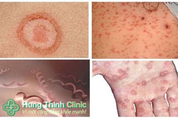 Nguyên nhân bệnh giang mai ở nam và nữ giớ