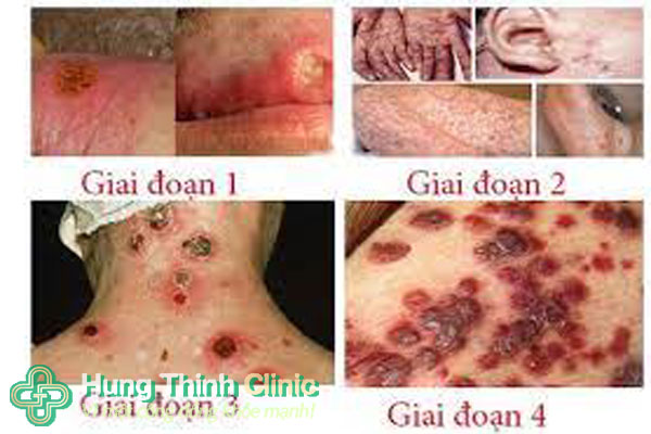 Dấu hiệu nhận biết, biểu hiện của bệnh giang mai