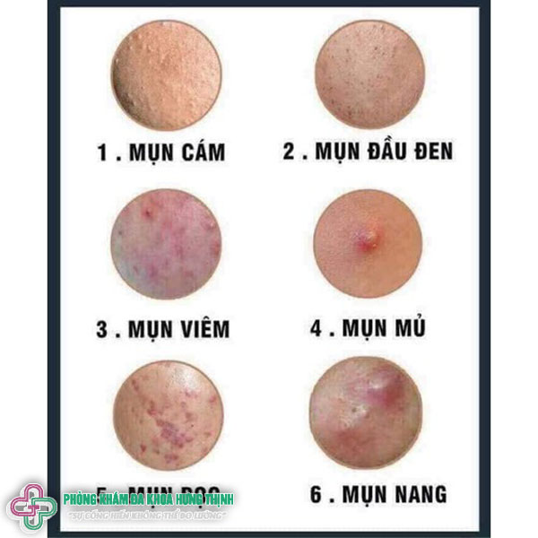 Biểu hiện của mụn trứng cá tuổi dậy thì