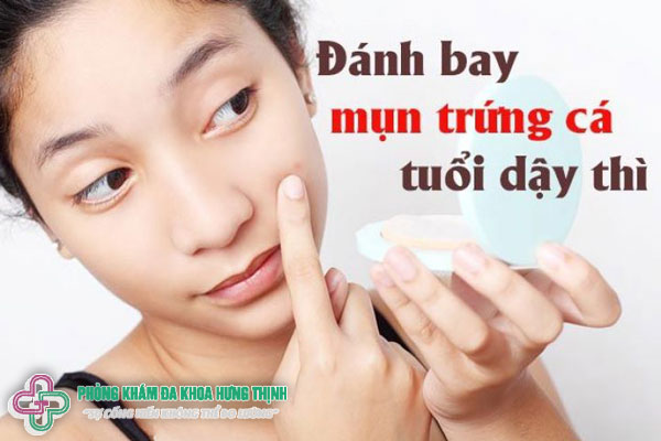 Cách điều trị mụn trứng cá tuổi dậy thì