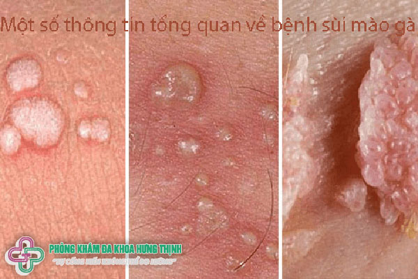 Một số thông tin tổng quan về bệnh sùi mào gà