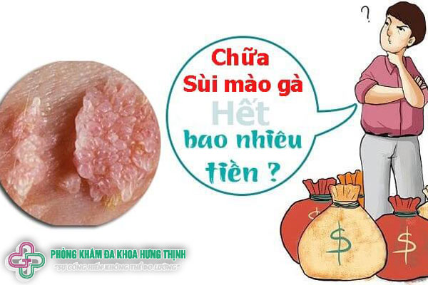 Chi phí chữa sùi mào gà hết bao nhiêu tiền?