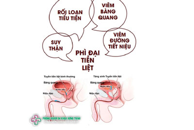 Nguyên nhân tiểu rắt
