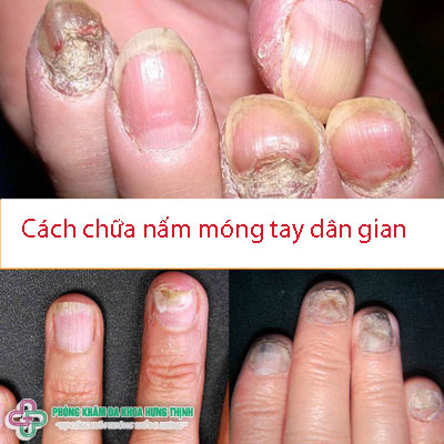 Cách chữa nấm móng tay dân gian
