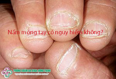 Nấm móng tay có nguy hiểm không?
