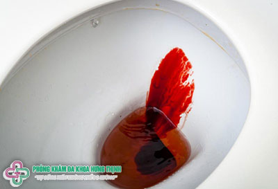Những nguy hiểm có thể xảy ra do đi cầu ra máu