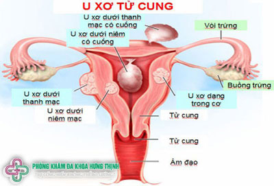 U xơ cổ tử cung