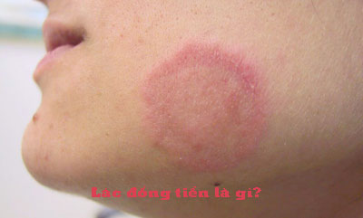 Lác đồng tiền là gì?
