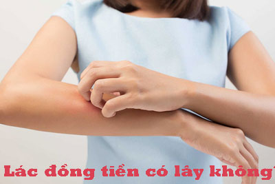 Lác đồng tiền có lây không?