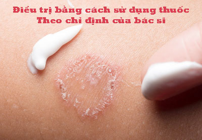 Điều trị bằng cách sử dụng thuốc theo chỉ định của bác sĩ