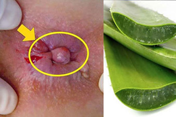 Cách chữa bệnh trĩ nội