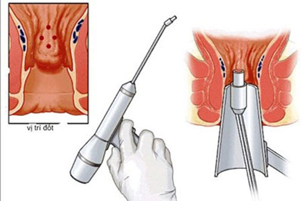 Cách điều trị trĩ