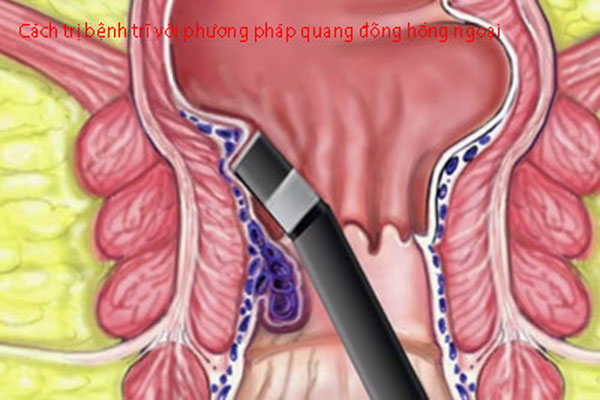Cách trị bệnh trĩ