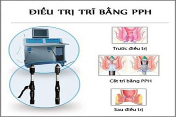 Cách điều trị bệnh trĩ